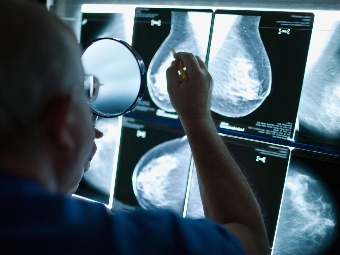 Study: Third of Breast Cancer Patients Treated Unnecessarily