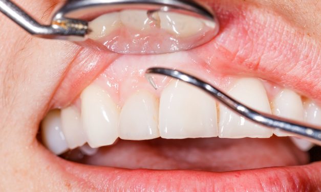 Make your dentist proud. Grow back your receding gums- holistically.
