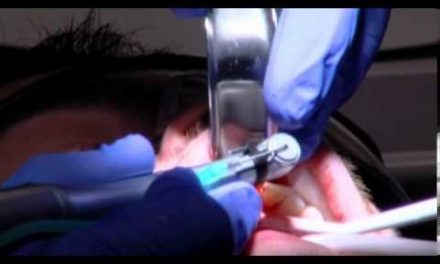 Grow New Teeth With Stem-Cell Dental Implants!