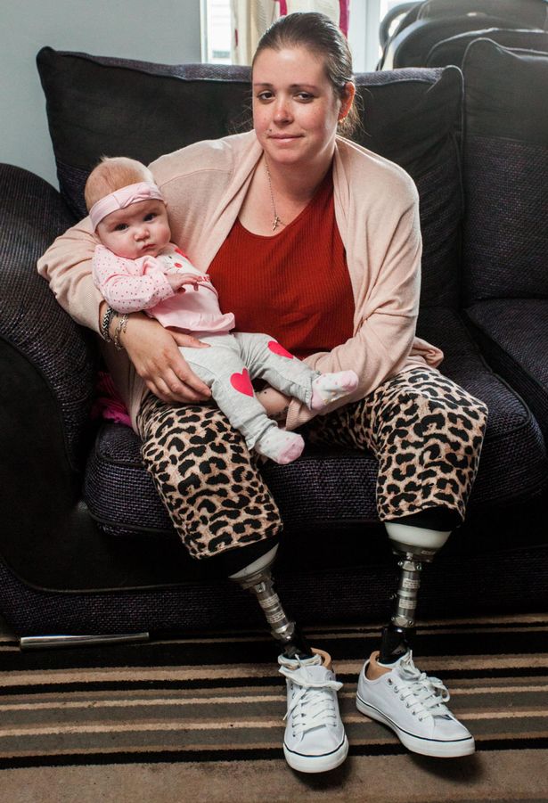 Mom Wakes From C-Section To Discover BOTH Legs Amputated