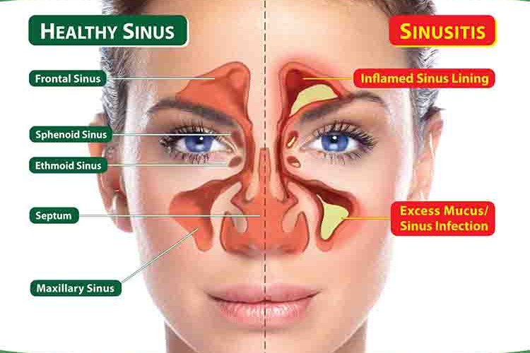 Clear Seriously BLOCKED Sinuses NATURALLY In 1 Minute