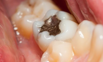 Killer In Your Mouth: Remove Amalgam Fillings And You Will Be Healed Of Many Diseases