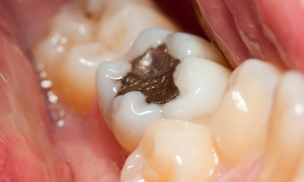 5.1 TONS of mercury per year from fillings in your teeth can’t go down public sewers anymore, EPA rules