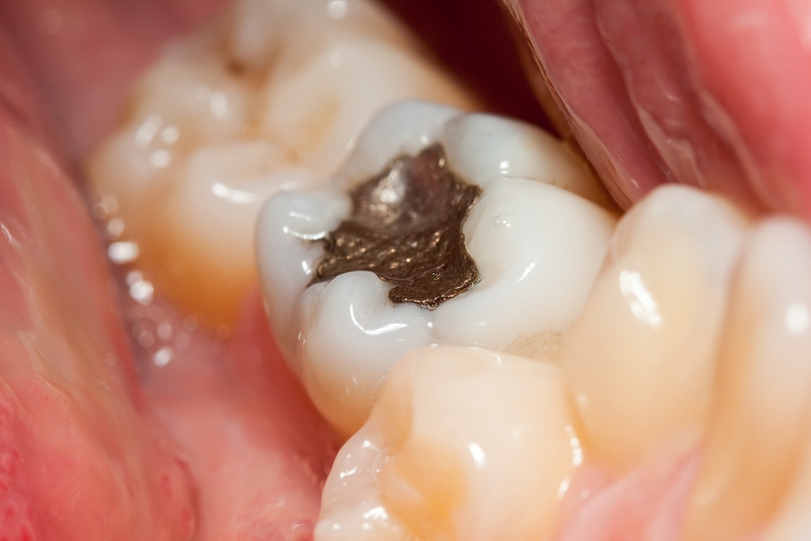 5.1 TONS of mercury per year from fillings in your teeth can’t go down public sewers anymore, EPA rules