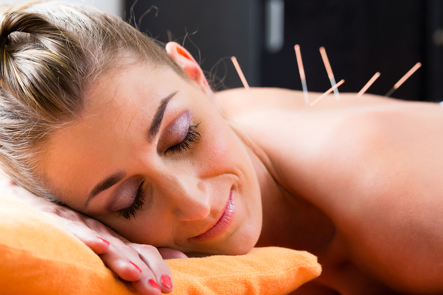 Study finds Acupuncture shows Promise in Migraine Treatment