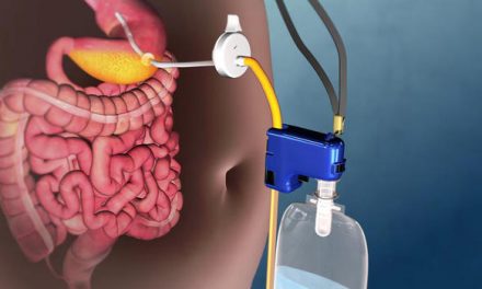 Stomach Pump Device For Weight Loss Approved By FDA