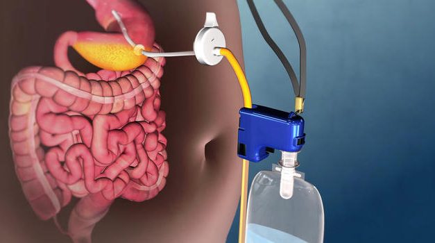 Stomach Pump Device For Weight Loss Approved By FDA