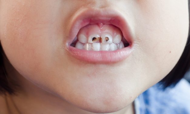 Oil Pulling: Research Finally Reveals What Some Have Thought All Along