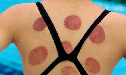 Cupping Is the New Thing: Olympic Swimmers Go Holistic