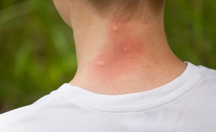 what-attracts-mosquitoes-and-how-to-repel-them