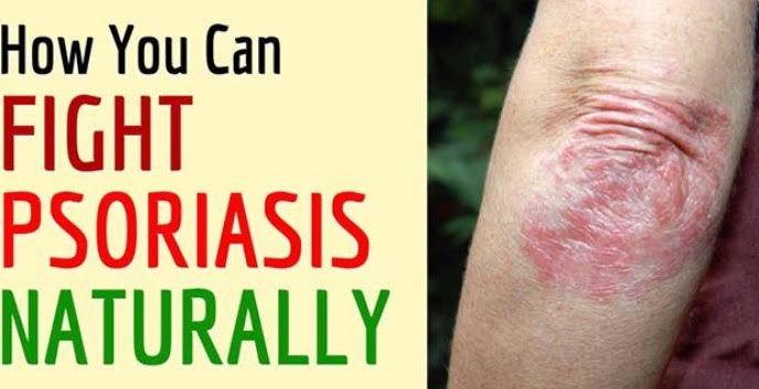 How Psoriasis Treatment Costs Us Billions