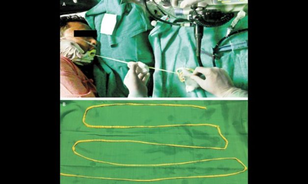 Doctors in India Remove 6-foot Tapeworm Through Man’s Mouth