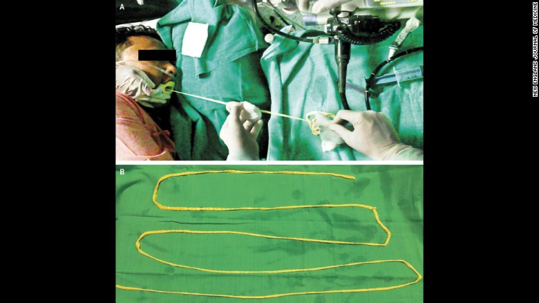 Doctors in India Remove 6-foot Tapeworm Through Man’s Mouth