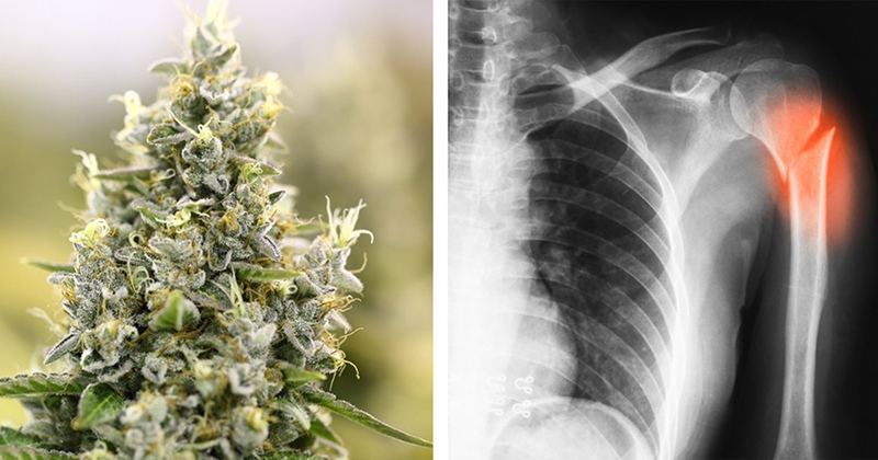 Scientists Discover Marijuana Helps Heal Broken Bones, & Even Makes Them Stronger