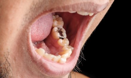 Are Cavities Contagious?