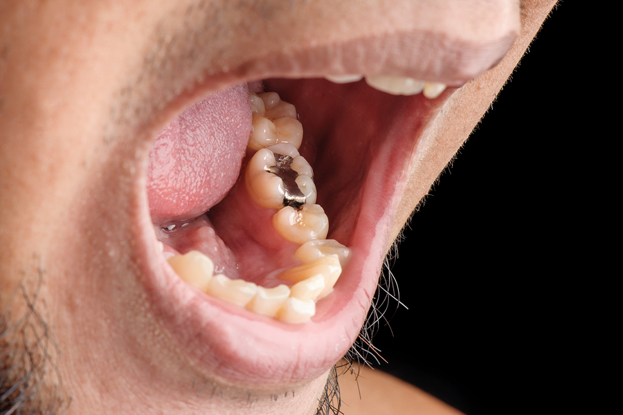Are Cavities Contagious?