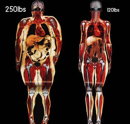 Review of 200 Studies Confirms That Every Pound Gained Increases Risk of Many Cancers
