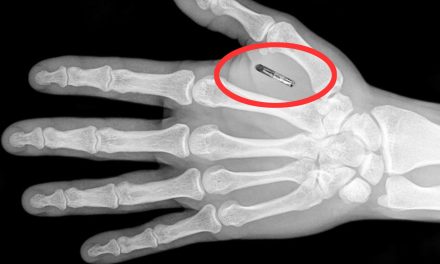 Australian, Swedish & U.S. companies are microchipping their employees at alarming rates!