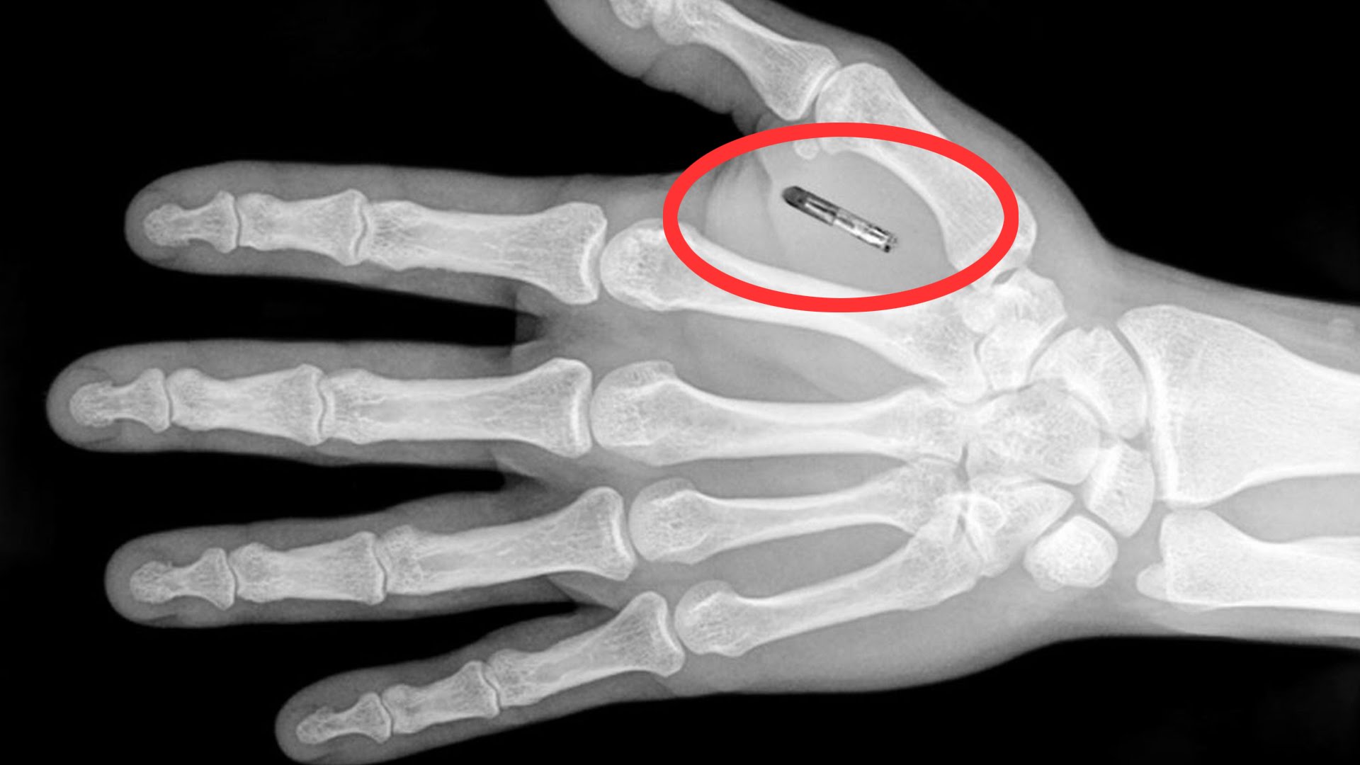 Australian, Swedish & U.S. companies are microchipping their employees at alarming rates!