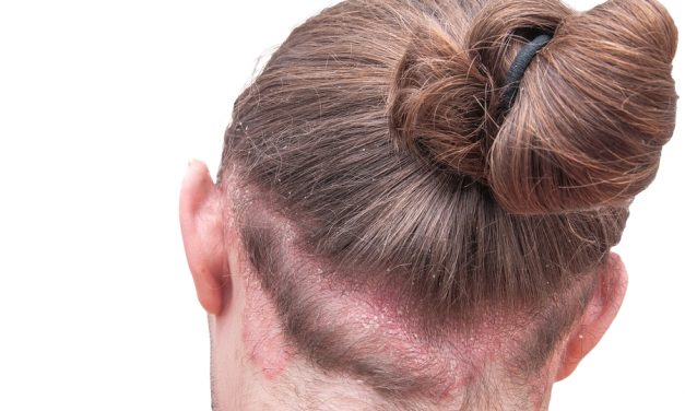 Eczema treatment with Evening Primrose Oil, Borage Oil vs. Hempseed Oil OR diet