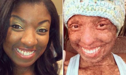 Woman says her skin burned from inside out after dosage error