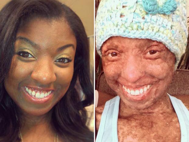 Woman says her skin burned from inside out after dosage error