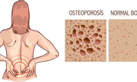 The Manufacturing of Bone Diseases: The story of osteoporosis and osteopenia