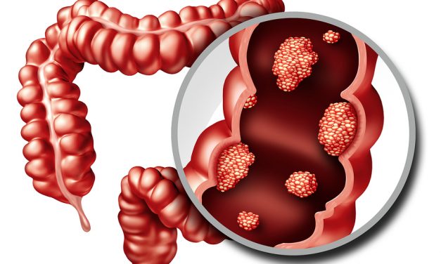 Stop creating so many free radicals in your colon