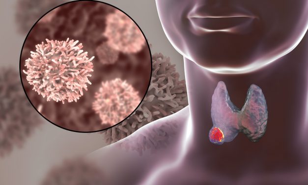 ‘Overdiagnosis epidemic’ in thyroid cancer: University of Calgary researchers