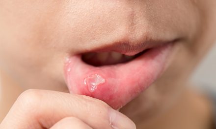 Topical honey for canker sores