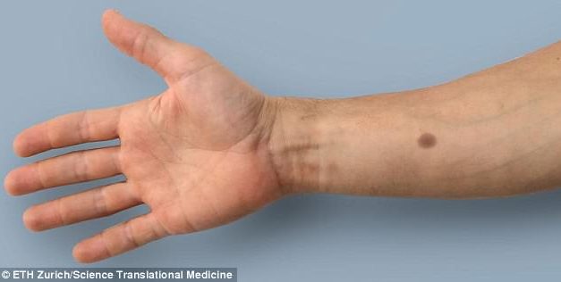 Skin implant creates an artificial ‘mole’ if people are at a high risk of breast or prostate cancer, scientists claim