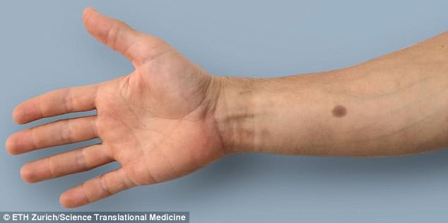 Skin implant creates an artificial ‘mole’ if people are at a high risk of breast or prostate cancer, scientists claim