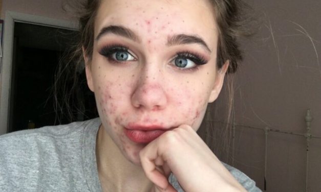 NBC: Woman who almost went blind from her acne medication is now warning others