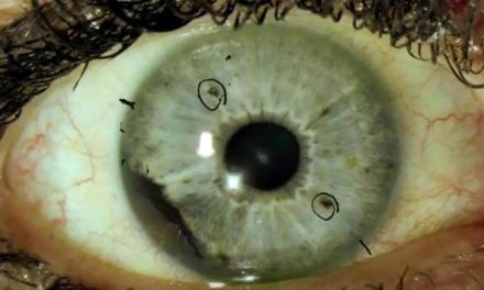CNN: Group of rare eye cancer cases baffles experts