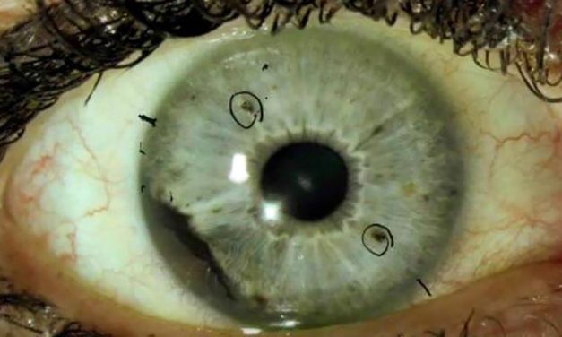 CNN: Group of rare eye cancer cases baffles experts