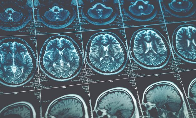 Dozens diagnosed with rare brain tumors in small rural area