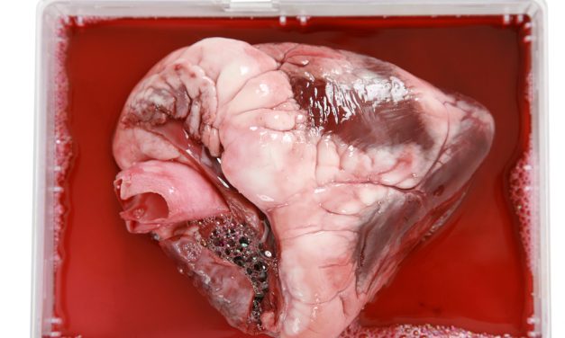 World renowned heart surgeon speaks out on what really causes heart disease