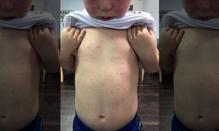 Georgia mom warns others after son, 5, contracts rare disease from tick bite