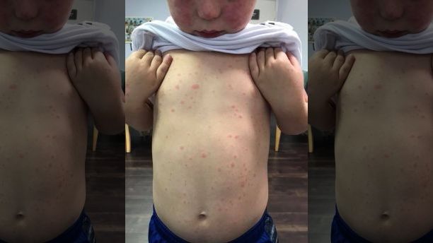 Georgia mom warns others after son, 5, contracts rare disease from tick bite
