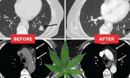 Lung cancer patient’s tumors shrunk in half after using CBD oil