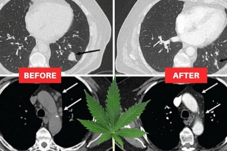 Lung cancer patient’s tumors shrunk in half after using CBD oil