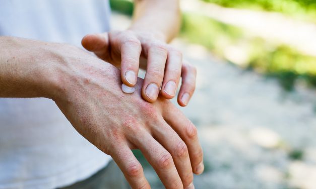 Want to cut your risk of dementia? Moisturize your skin, UCSF researchers say