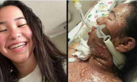 Fox: LA teenager’s skin ‘melts’ off in severe reaction to prescription medication with strict FDA warning