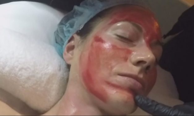CBS: Two diagnosed with HIV after getting ‘vampire facials’ at a spa